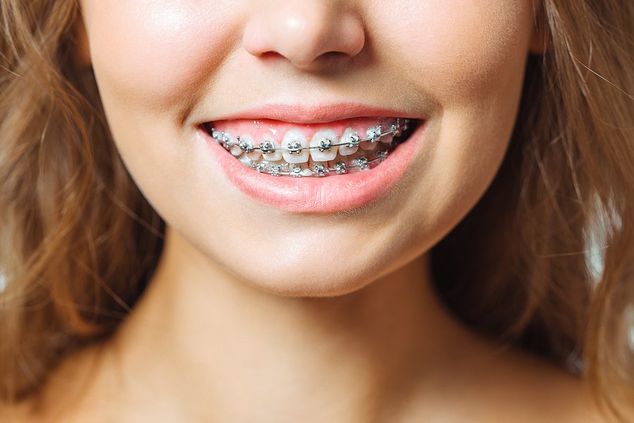 Family showing different age groups with braces